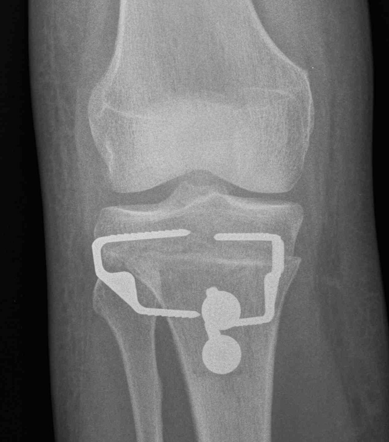Tibial Derotation Osteotomy